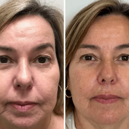 Resultados de la mascarilla de colágeno