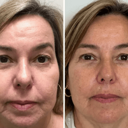 Resultados de la mascarilla de colágeno